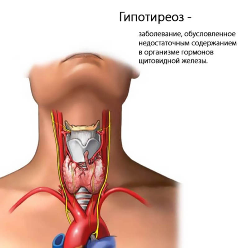 Лечение заболеваний щитовидной железы - лечение в Медлайн в Кемерово